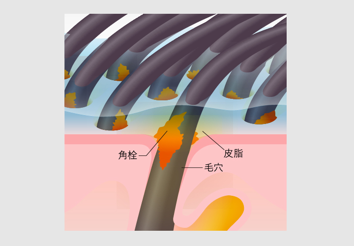 蓄積した頭皮角栓を分解する